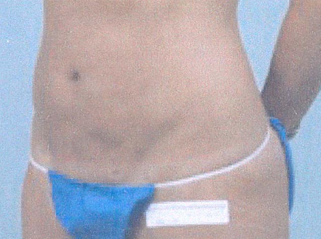 Scanned image from brochure used to promote laser liposuction machine