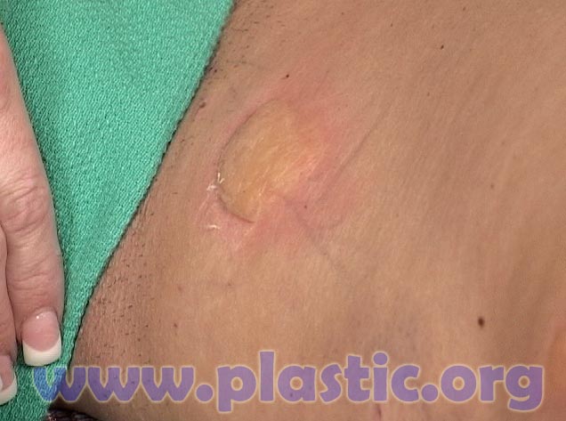 Burn caused by laser liposuction