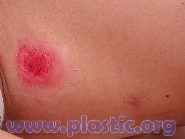 Burn caused by laser liposuction