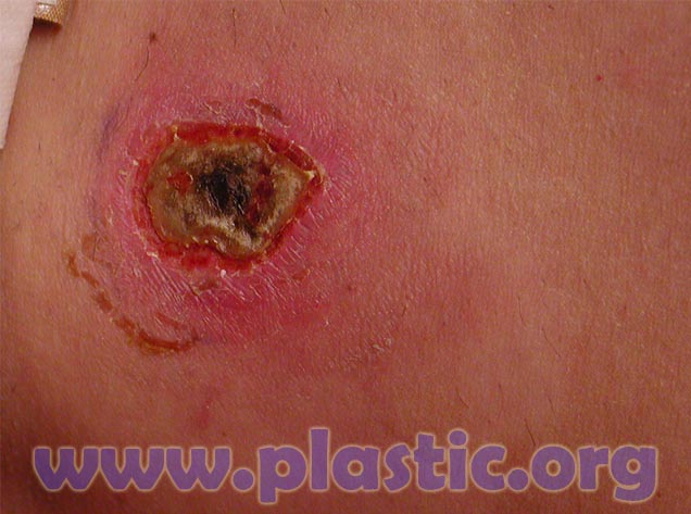 Burn caused by laser liposuction