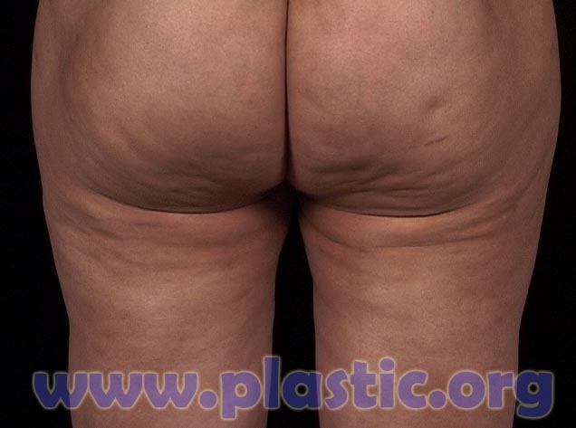 Irregularities and burns caused by laser liposuction