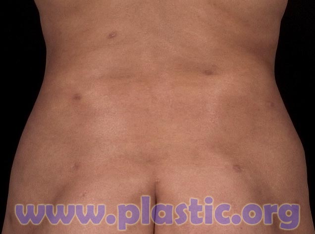 Irregularities and burns caused by laser liposuction